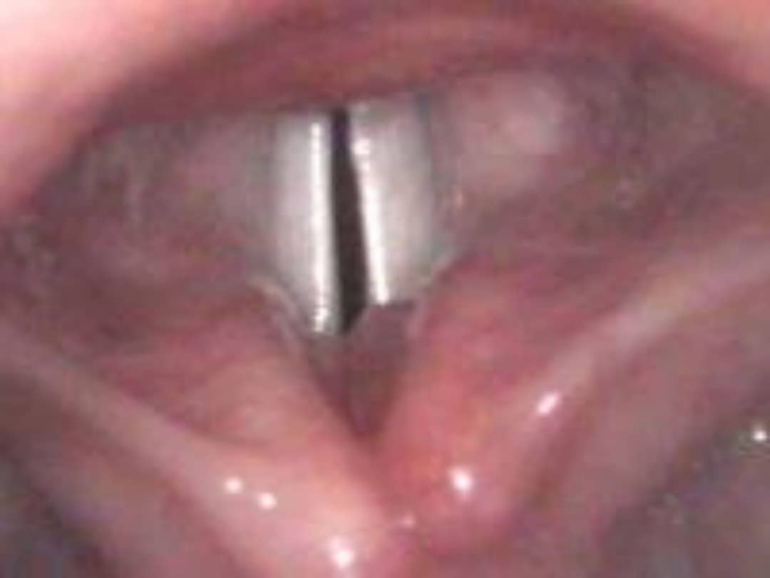 voz quebradiza