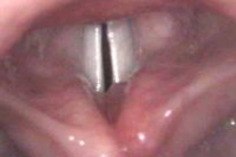 voz quebradiza